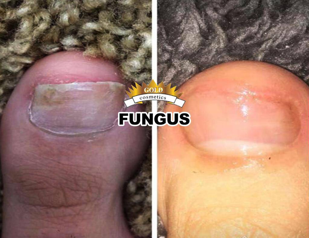 Nail Fungus Sales Page
